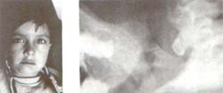 Microsomía Hemifacial con Displasia