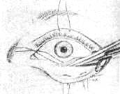 Protección del globo ocular