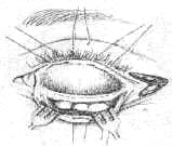 Protección del globo ocular