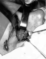 Reposicion de los tejidos