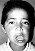 Osteomielitis mandibular a la edad de 7 años