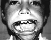 Levognatismo mandibular