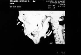 Reconstrucción mandibular