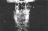 Gran Lesión Quística - Quistes Ontogénicos Gran Lesión Quística - Quistes Ontogénicos