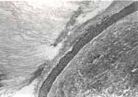 Epitelio Escamoso - Quistes Ontogénicos Epitelio Escamoso - Quistes Ontogénicos