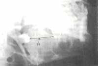 Migración del Tercer Molar - Quistes Ontogénicos Migración del Tercer Molar - Quistes Ontogénicos