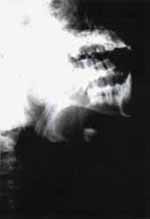 Reabsorción radicular del primer molar - Quistes Ontogénicos Reabsorción radicular del primer molar - Quistes Ontogénicos