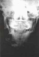 Reabsorción Radicular del Primer Molar - Quistes Ontogénicos Reabsorción Radicular del Primer Molar - Quistes Ontogénicos