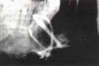 Aspectos angliograficos – Quistes Ontogénicos Aspectos angliograficos – Quistes Ontogénicos