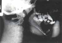 Lesión Quística - Quistes Ontogénicos Lesión Quística - Quistes Ontogénicos