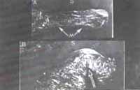 Fibras colágenas en el disco