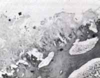 Condromalacia, grado III