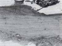 Osteoartrosis severa