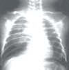 Dificultad respiratoria Dificultad respiratoria