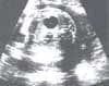 Lesión intrapulmonar derecha en Malformación Adenomatoide Quística Lesión intrapulmonar derecha en Malformación Adenomatoide Quística