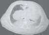 Soporte ventilatorioen en Malformación Adenomatoide Quística Soporte ventilatorioen en Malformación Adenomatoide Quística