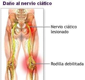 Daño del nervio ciático 