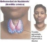 Enfermedad de Hashimoto