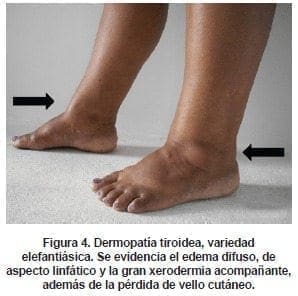 Dermopatía tiroidea Dermopatía tiroidea