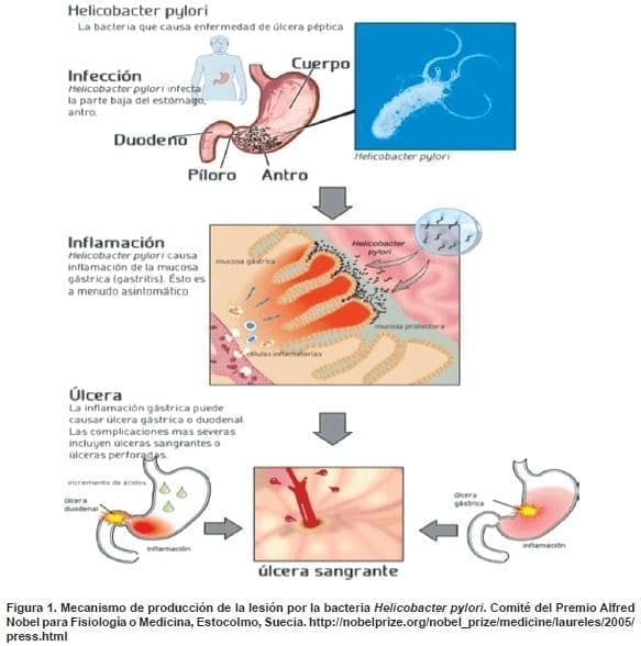 Lesión por la bacteria Helicobacter pylori Lesión por la bacteria Helicobacter pylori