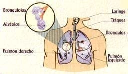 Bronquitis - afecta sistema respiratorio