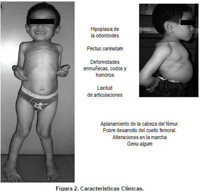 Fenotipo clásico de mucopolisacaridosis IV A Fenotipo clásico de mucopolisacaridosis IV A