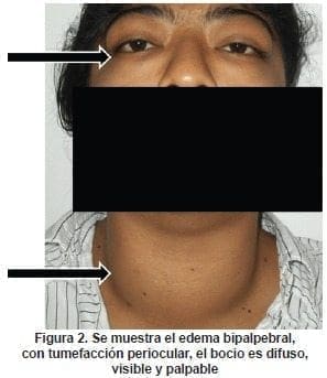 Edema Bipalpebral Edema Bipalpebral