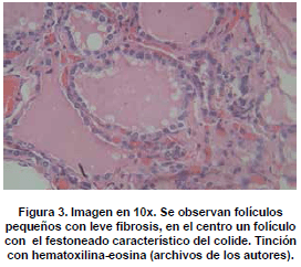 Folículos pequeños con leve fibrosis Folículos pequeños con leve fibrosis