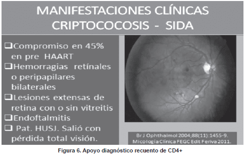 Manifestaciones clínicas criptococosis - sida