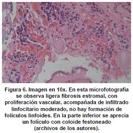 Fibrosis estromal Fibrosis estromal