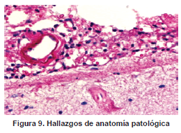 Arteritis granulomatosa del polígono de Willis