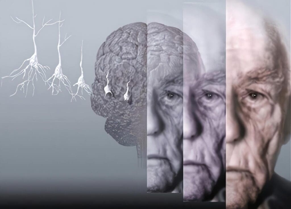 guía de alzheimer