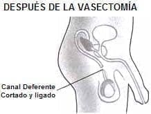 Organos de Reproducción Masculina, después de la vasectomía Organos de Reproducción Masculina, después de la vasectomía