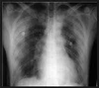 Rx Tórax AP con  infiltrados alveolares periféricos Rx Tórax AP con  infiltrados alveolares periféricos
