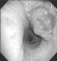 Fibrobroncoscopia con catéter para ultrasonido endobronquial Fibrobroncoscopia con catéter para ultrasonido endobronquial