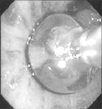 Catéter de endoscopia intrabronquial Catéter de endoscopia intrabronquial