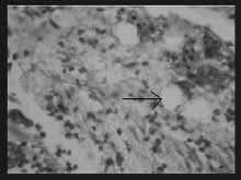 H-E. Vacuolas conteniendo material no birrefringente H-E. Vacuolas conteniendo material no birrefringente