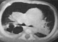 TAC de tórax en imágenes quísticas TAC de tórax en imágenes quísticas