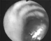 Tumor carcinoide bronquial típico, de localización central Tumor carcinoide bronquial típico, de localización central