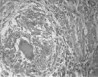 Biopsia de endometrio que muestra infiltrado linfocitario Biopsia de endometrio que muestra infiltrado linfocitario