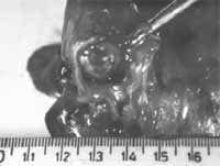 Patología Macroscópica de Tumor Carcinoide Endobronquial Patología Macroscópica de Tumor Carcinoide Endobronquial
