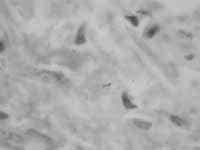 Biopsia de endometrio que muestra un bacilo ácido alcohol resistente Biopsia de endometrio que muestra un bacilo ácido alcohol resistente