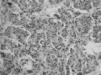 Patología Microscópica de Tumor Carcinoide Endobronquial Patología Microscópica de Tumor Carcinoide Endobronquial