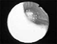 Tumor carcinoide endobronquial de localización central Tumor carcinoide endobronquial de localización central