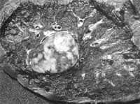 Patología macroscópica tumor carcinoide bronquial  Patología macroscópica tumor carcinoide bronquial