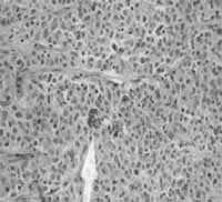 Patología Microscópica Tumor Carcinoide Bronquial Atípico Patología Microscópica Tumor Carcinoide Bronquial Atípico