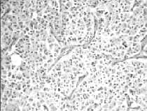 Patología microscópica de tumor carcinoide bronquial Patología microscópica de tumor carcinoide bronquial