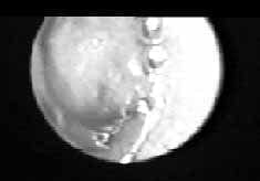 Tumor carcinoide endobronquial de localización central Tumor carcinoide endobronquial de localización central