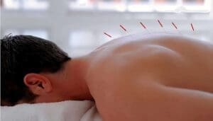 Acupuntura en Colombia