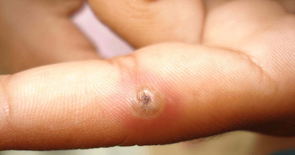 Investigación Original,  Tungiasis en Población Indígena del Departamento de Vaupés